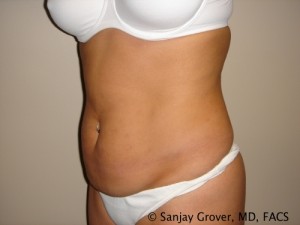 Tummy Tuck Before and After 43 | Sanjay Grover MD FACS