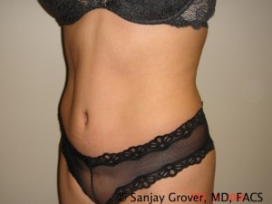 Tummy Tuck Before and After 43 | Sanjay Grover MD FACS