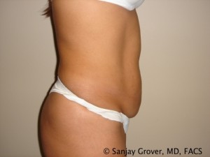 Tummy Tuck Before and After 43 | Sanjay Grover MD FACS