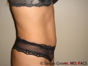 Tummy Tuck Before and After 43 | Sanjay Grover MD FACS