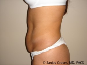 Tummy Tuck Before and After 43 | Sanjay Grover MD FACS