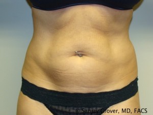Tummy Tuck Before and After | Grover Aesthetics