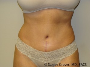 Tummy Tuck Before and After | Grover Aesthetics