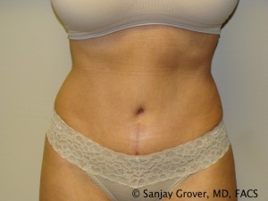 Tummy Tuck Before and After 44 | Sanjay Grover MD FACS