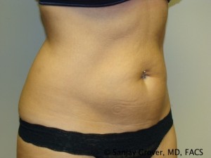 Tummy Tuck Before and After 44 | Sanjay Grover MD FACS