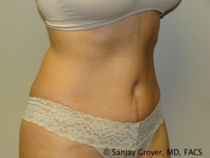 Tummy Tuck Before and After 44 | Sanjay Grover MD FACS