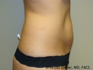 Tummy Tuck Before and After 44 | Sanjay Grover MD FACS