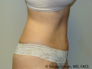 Tummy Tuck Before and After 44 | Sanjay Grover MD FACS