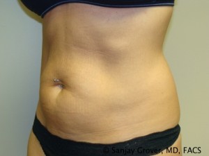 Tummy Tuck Before and After 44 | Sanjay Grover MD FACS