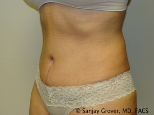 Tummy Tuck Before and After 44 | Sanjay Grover MD FACS