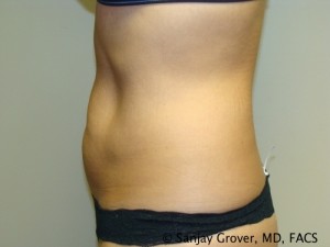 Tummy Tuck Before and After 44 | Sanjay Grover MD FACS