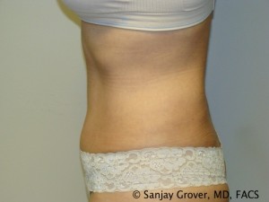 Tummy Tuck Before and After 44 | Sanjay Grover MD FACS