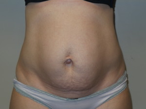 Tummy Tuck Before and After | Grover Aesthetics