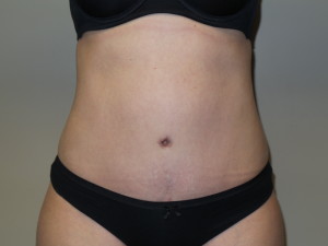 Tummy Tuck Before and After | Grover Aesthetics