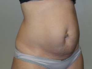 Tummy Tuck Before and After 45 | Sanjay Grover MD FACS