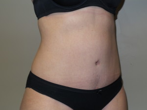 Tummy Tuck Before and After 45 | Sanjay Grover MD FACS