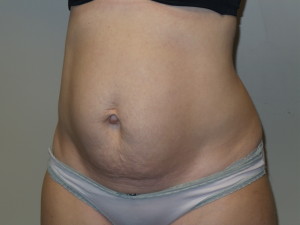 Tummy Tuck Before and After 45 | Sanjay Grover MD FACS