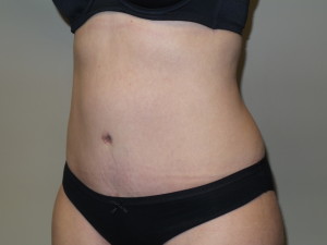 Tummy Tuck Before and After 45 | Sanjay Grover MD FACS