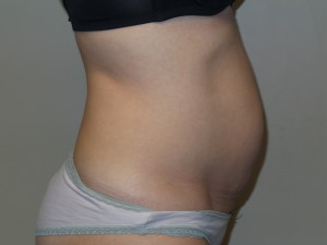 Tummy Tuck Before and After 45 | Grover Aesthetics