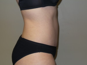Tummy Tuck Before and After 45 | Grover Aesthetics