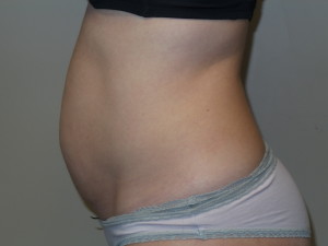 Tummy Tuck Before and After 45 | Grover Aesthetics