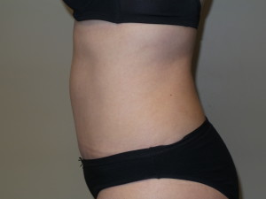 Tummy Tuck Before and After 45 | Sanjay Grover MD FACS