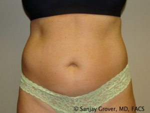 Tummy Tuck Before and After 97 | Sanjay Grover MD FACS