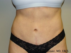 Tummy Tuck Before and After | Grover Aesthetics