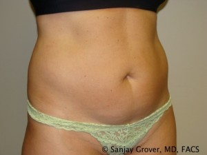 Tummy Tuck Before and After 46 | Grover Aesthetics