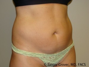 Tummy Tuck Before and After 46 | Sanjay Grover MD FACS