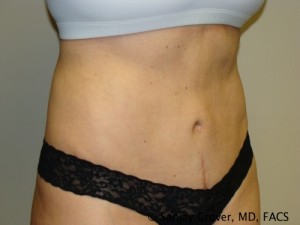 Tummy Tuck Before and After 46 | Sanjay Grover MD FACS