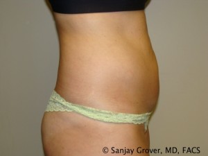 Tummy Tuck Before and After 46 | Sanjay Grover MD FACS