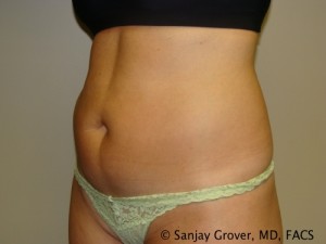 Tummy Tuck Before and After 46 | Sanjay Grover MD FACS