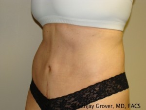 Tummy Tuck Before and After 46 | Sanjay Grover MD FACS