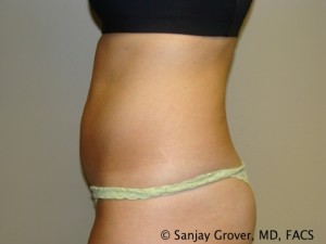 Tummy Tuck Before and After 46 | Sanjay Grover MD FACS