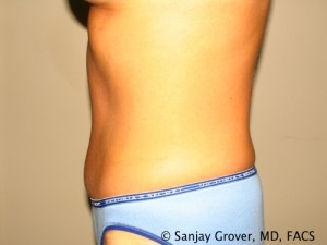 Tummy Tuck Before and After 46 | Sanjay Grover MD FACS