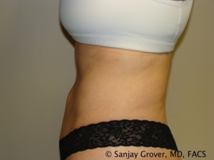 Tummy Tuck Before and After 46 | Sanjay Grover MD FACS