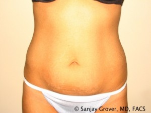 Tummy Tuck Before and After | Grover Aesthetics