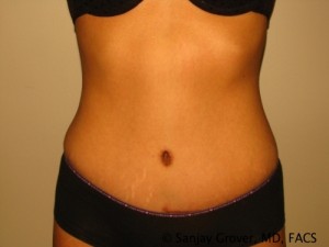 Tummy Tuck Before and After | Grover Aesthetics