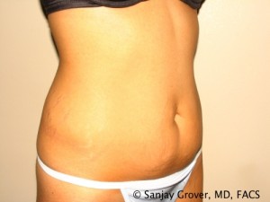 Tummy Tuck Before and After 47 | Sanjay Grover MD FACS