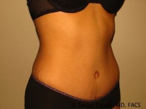 Tummy Tuck Before and After 47 | Grover Aesthetics