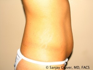 Tummy Tuck Before and After 47 | Sanjay Grover MD FACS