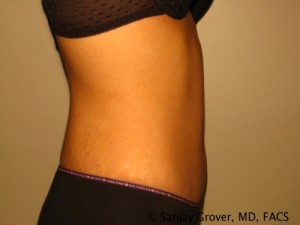 Tummy Tuck Before and After 47 | Sanjay Grover MD FACS