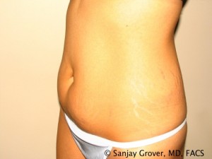 Tummy Tuck Before and After 47 | Sanjay Grover MD FACS