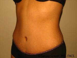 Tummy Tuck Before and After 47 | Grover Aesthetics
