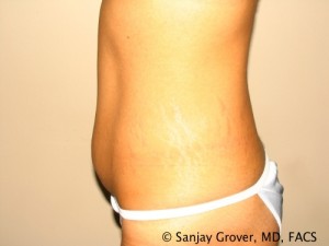 Tummy Tuck Before and After 47 | Grover Aesthetics