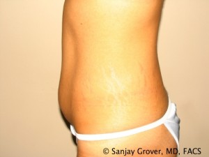 Tummy Tuck Before and After 47 | Sanjay Grover MD FACS