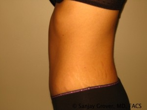 Tummy Tuck Before and After 47 | Sanjay Grover MD FACS