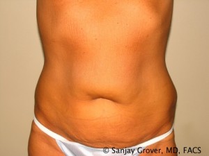 Tummy Tuck Before and After 09 | Sanjay Grover MD FACS