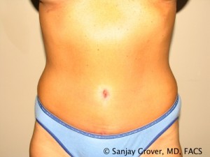 Tummy Tuck Before and After | Grover Aesthetics